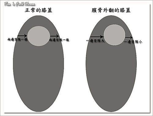 臏骨外翻之我是富貴命